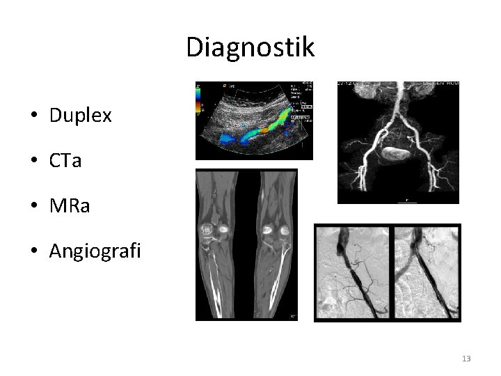 Diagnostik • Duplex • CTa • MRa • Angiografi 13 