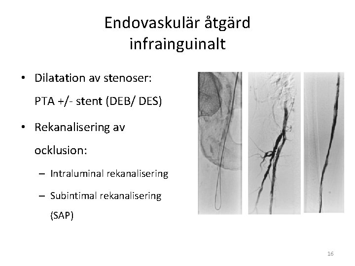 Endovaskulär åtgärd infrainguinalt • Dilatation av stenoser: PTA +/- stent (DEB/ DES) • Rekanalisering