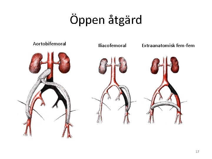 Öppen åtgärd Aortobifemoral Iliacofemoral Extraanatomisk fem-fem 17 