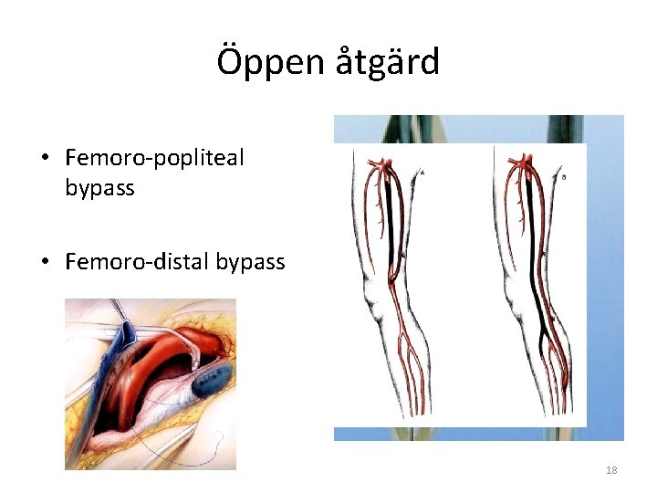 Öppen åtgärd • Femoro-popliteal bypass • Femoro-distal bypass 18 