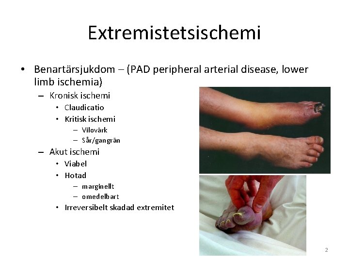 Extremistetsischemi • Benartärsjukdom – (PAD peripheral arterial disease, lower limb ischemia) – Kronisk ischemi