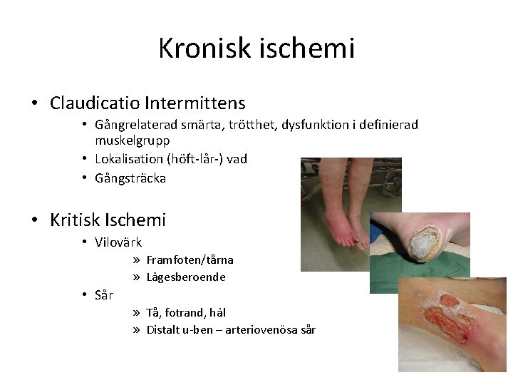 Kronisk ischemi • Claudicatio Intermittens • Gångrelaterad smärta, trötthet, dysfunktion i definierad muskelgrupp •