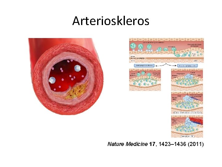 Arterioskleros Nature Medicine 17, 1423– 1436 (2011) 