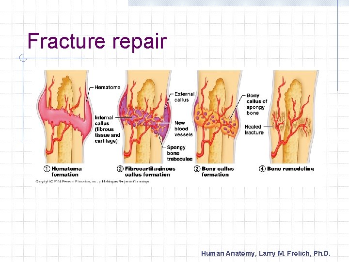 Fracture repair Human Anatomy, Larry M. Frolich, Ph. D. 