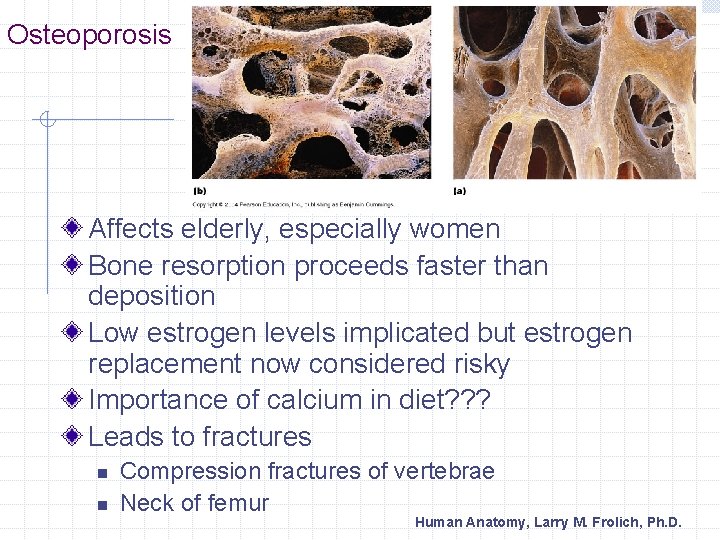 Osteoporosis Affects elderly, especially women Bone resorption proceeds faster than deposition Low estrogen levels