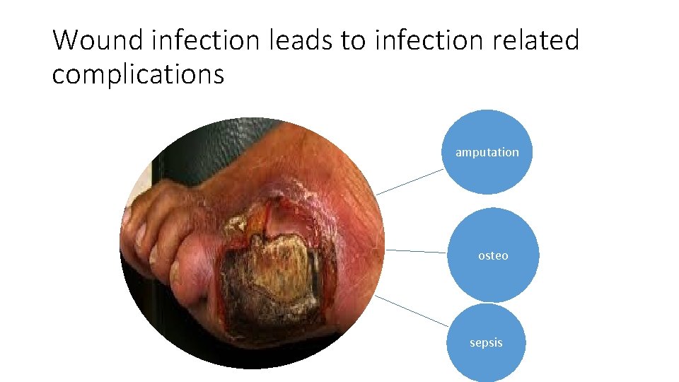 Wound infection leads to infection related complications amputation osteo sepsis 