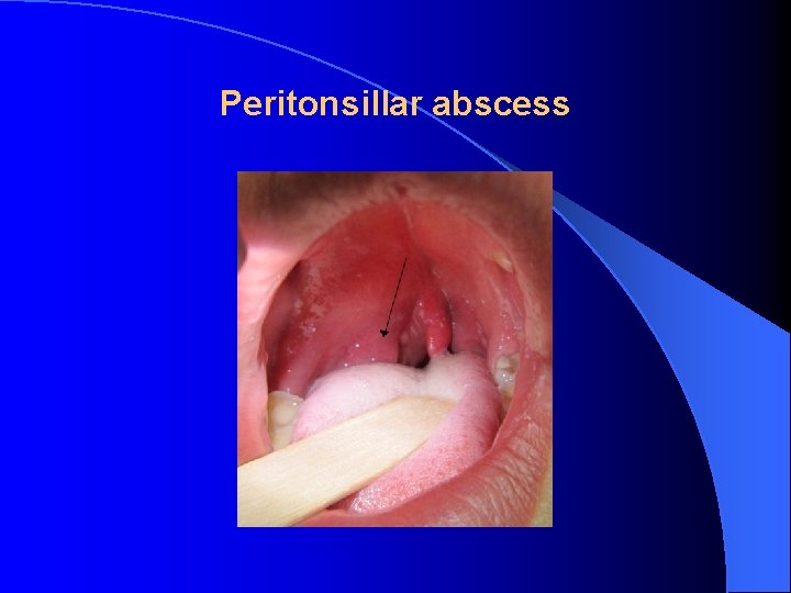 Peritonsillar abscess 