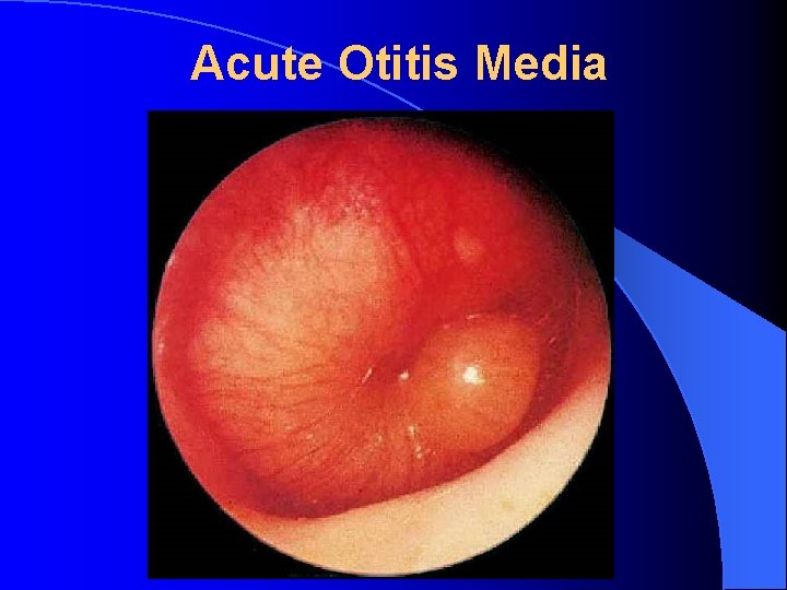 Acute Otitis Media 