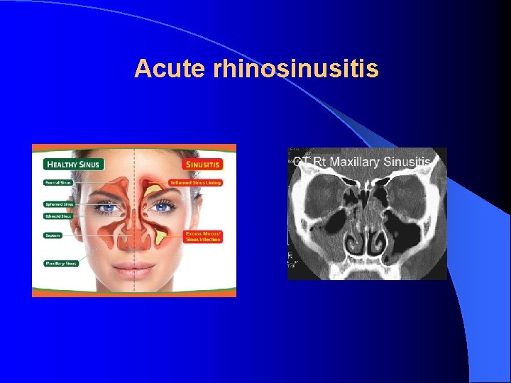 Acute rhinosinusitis 