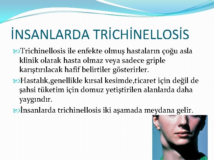 İNSANLARDA TRİCHİNELLOSİS Trichinellosis ile enfekte olmuş hastaların çoğu asla klinik olarak hasta olmaz veya