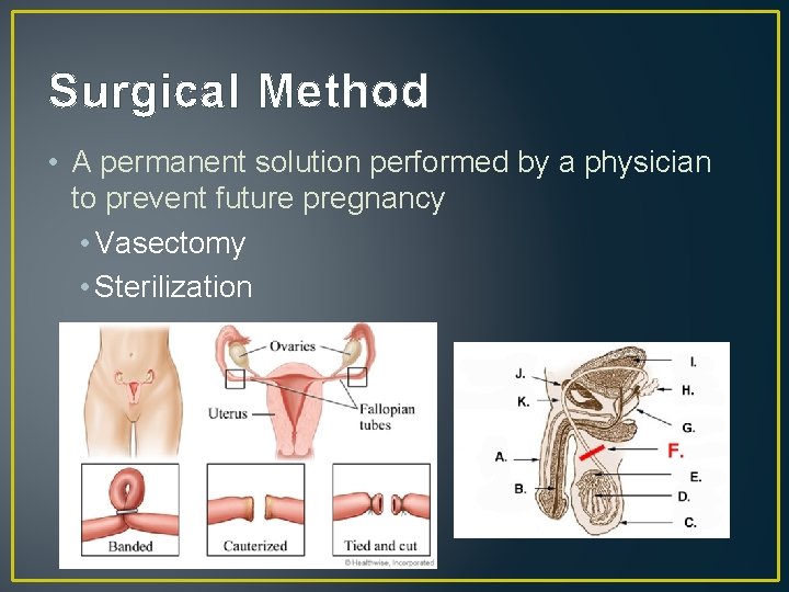 Surgical Method • A permanent solution performed by a physician to prevent future pregnancy