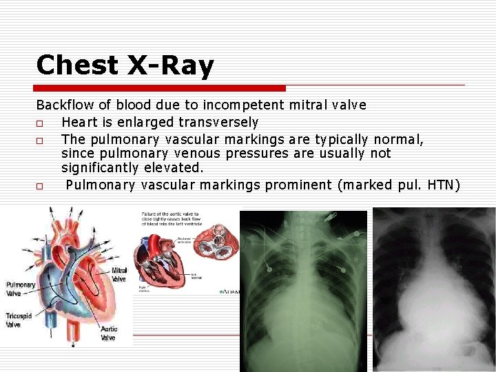 Chest X-Ray Backflow of blood due to incompetent mitral valve o Heart is enlarged