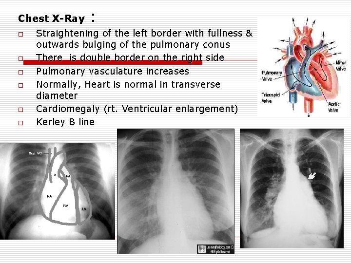 Chest X-Ray o o o : Straightening of the left border with fullness &