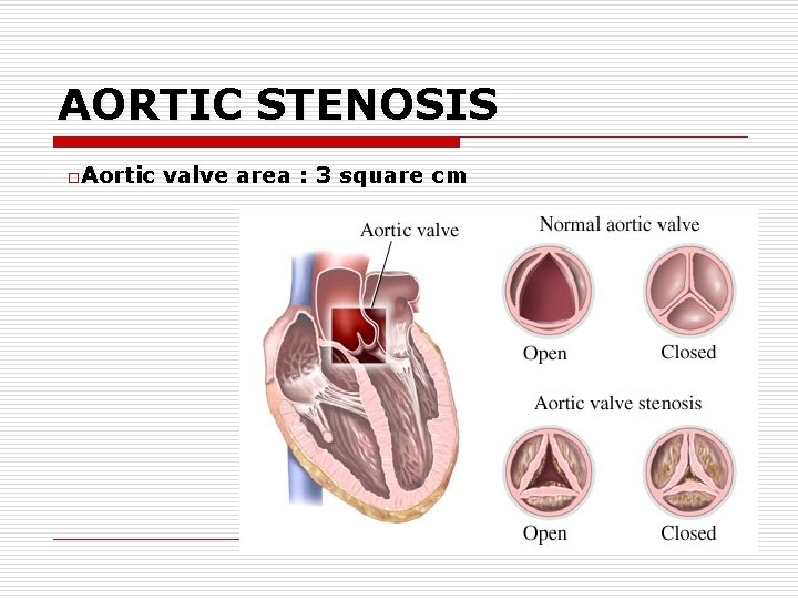 AORTIC STENOSIS o. Aortic valve area : 3 square cm 