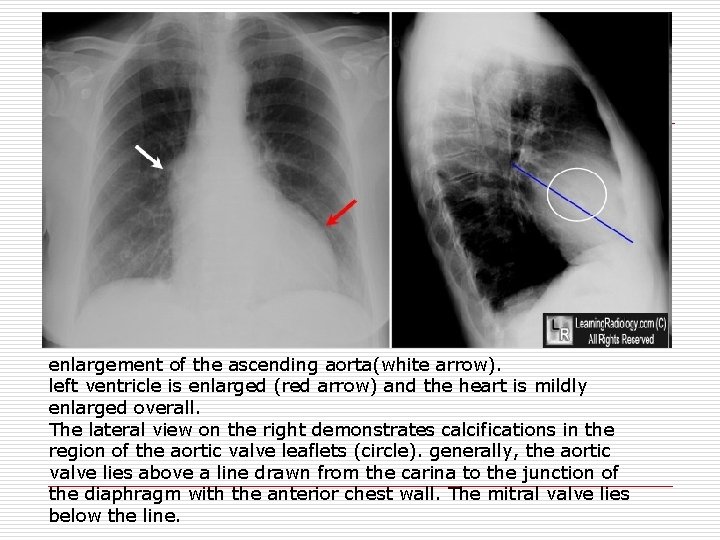 enlargement of the ascending aorta(white arrow). left ventricle is enlarged (red arrow) and the