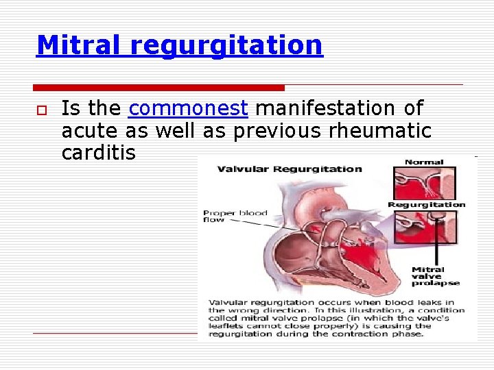 Mitral regurgitation o Is the commonest manifestation of acute as well as previous rheumatic