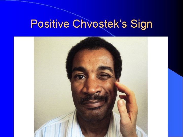 Positive Chvostek’s Sign 