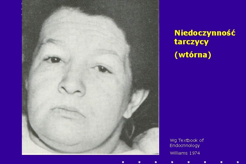 Niedoczynność tarczycy (wtórna) Wg Textbook of Endocrinology Williams 1974 