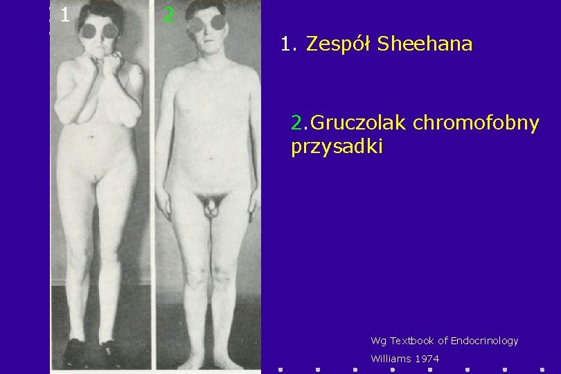 1 2 1. Zespół Sheehana 2. Gruczolak chromofobny przysadki Wg Textbook of Endocrinology Williams