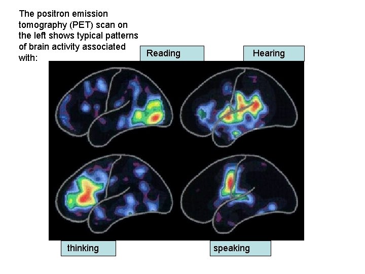 The positron emission tomography (PET) scan on the left shows typical patterns of brain