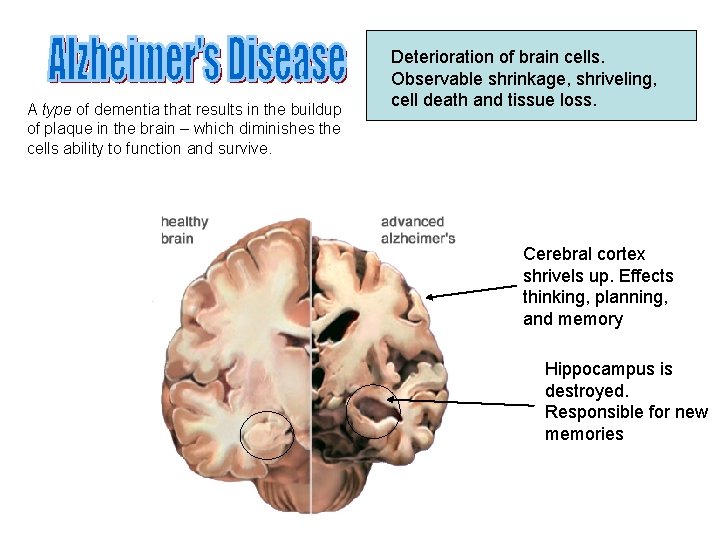A type of dementia that results in the buildup of plaque in the brain