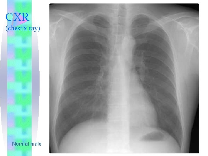 CXR (chest x ray) Normal male 