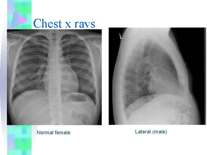 Chest x rays Normal female Lateral (male) 