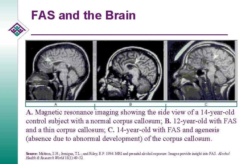 FAS and the Brain A A B C A. Magnetic resonance imaging showing the