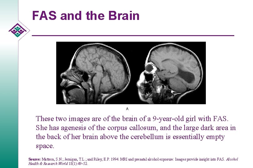 FAS and the Brain A These two images are of the brain of a