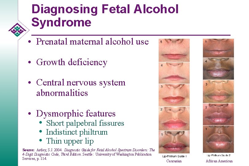 Diagnosing Fetal Alcohol Syndrome • Prenatal maternal alcohol use • Growth deficiency • Central