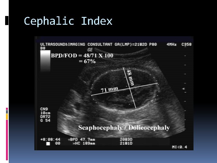 Cephalic Index 