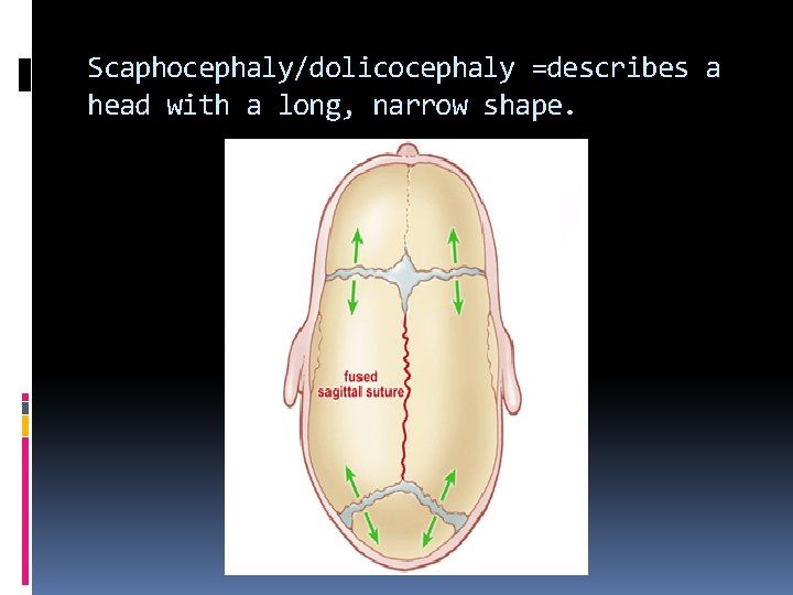 Scaphocephaly/dolicocephaly =describes a head with a long, narrow shape. 