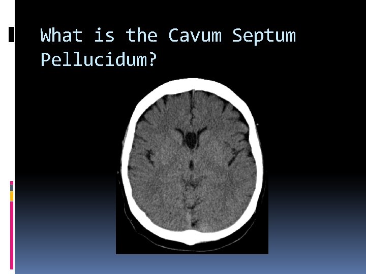 What is the Cavum Septum Pellucidum? 