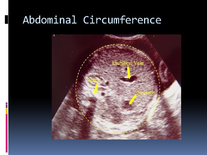 Abdominal Circumference 