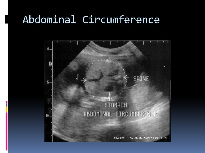 Abdominal Circumference 
