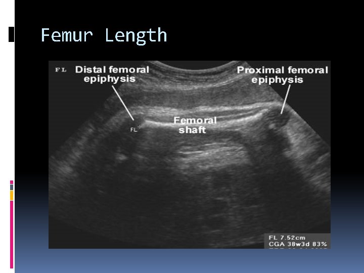 Femur Length 