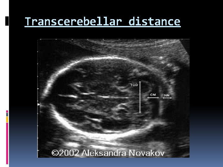Transcerebellar distance 