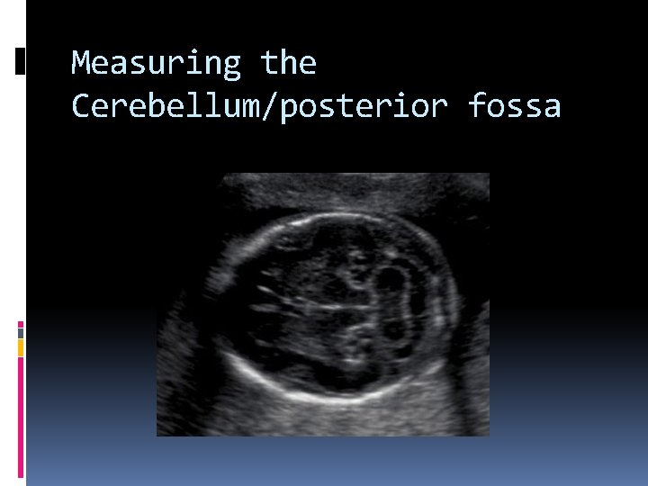 Measuring the Cerebellum/posterior fossa 