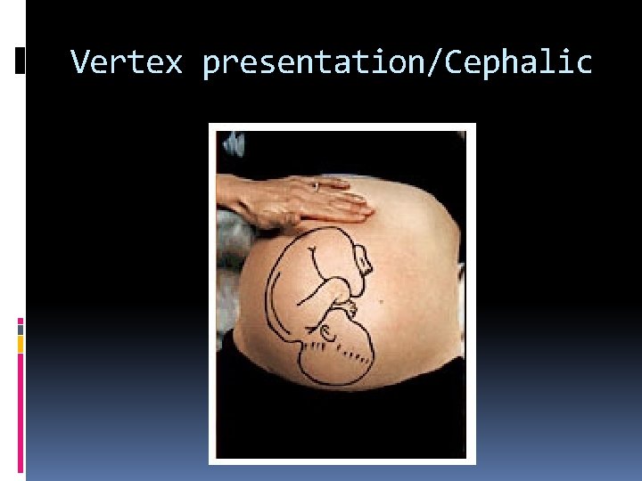 Vertex presentation/Cephalic 