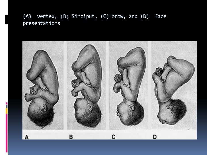 (A) vertex, (B) Sinciput, (C) brow, and (D) face presentations 