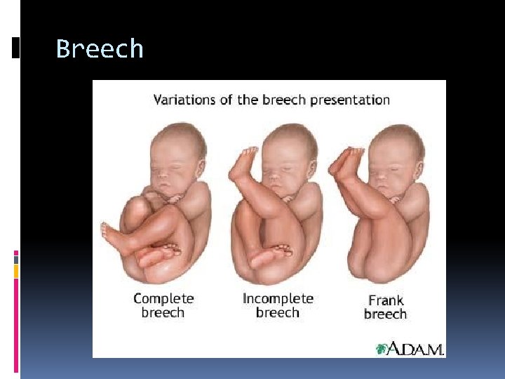 Breech 