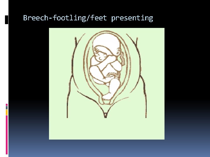 Breech-footling/feet presenting 