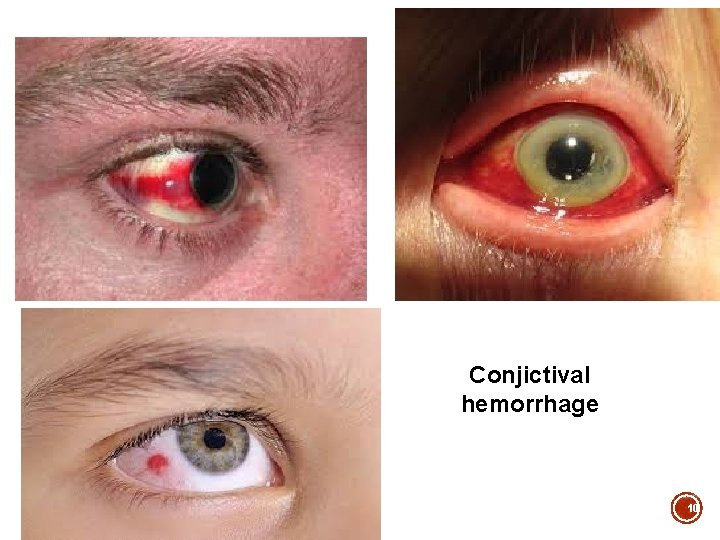 Conjictival hemorrhage 10 