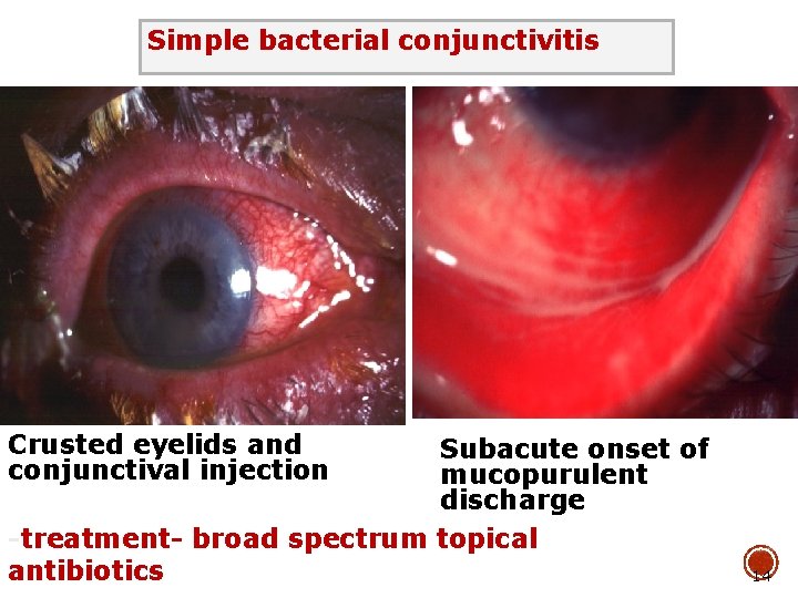Simple bacterial conjunctivitis Crusted eyelids and conjunctival injection Subacute onset of mucopurulent discharge -treatment-