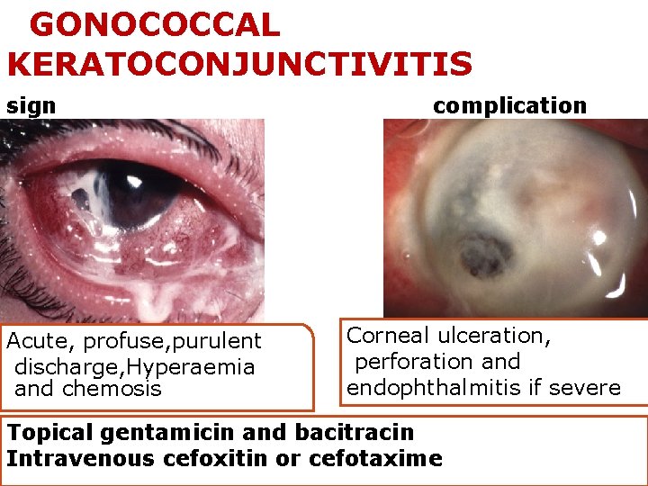 GONOCOCCAL KERATOCONJUNCTIVITIS sign Acute, profuse, purulent discharge, Hyperaemia and chemosis complication Corneal ulceration, perforation