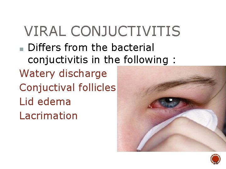 VIRAL CONJUCTIVITIS Differs from the bacterial conjuctivitis in the following : Watery discharge Conjuctival