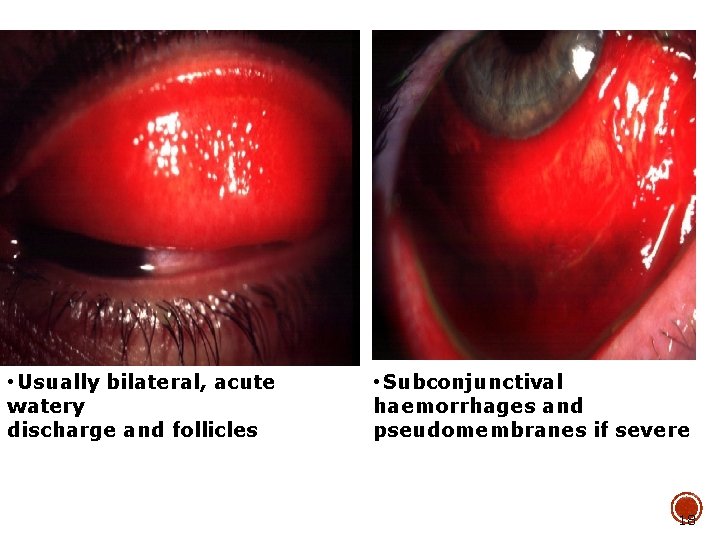  • Usually bilateral, acute watery discharge and follicles • Subconjunctival haemorrhages and pseudomembranes