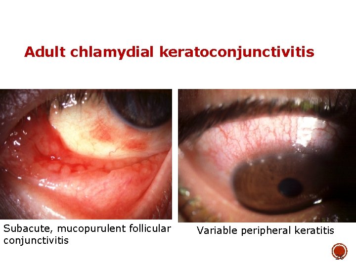 Adult chlamydial keratoconjunctivitis Subacute, mucopurulent follicular conjunctivitis Variable peripheral keratitis 26 