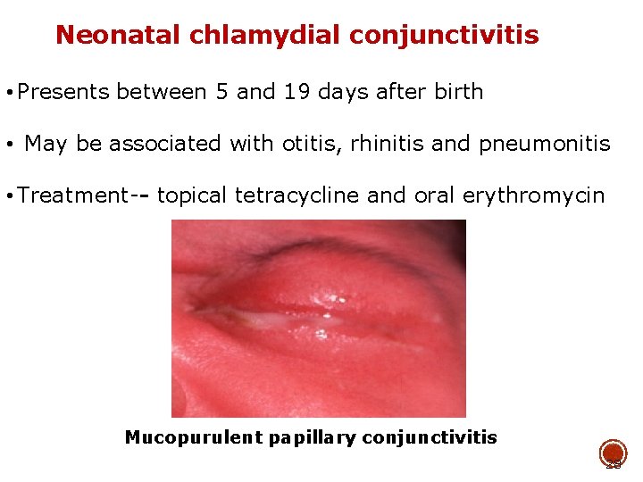 Neonatal chlamydial conjunctivitis • Presents between 5 and 19 days after birth • May