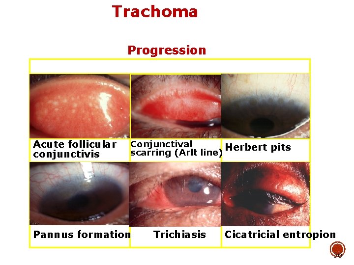 Trachoma Progression Acute follicular conjunctivis Conjunctival Herbert pits scarring (Arlt line) Pannus formation Trichiasis